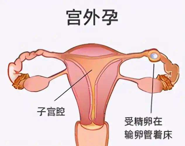 异位妊娠：当新生命“住错了地方”
